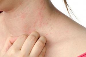 Chữa dị ứng thời tiết mỗi khi chuyển mùa
